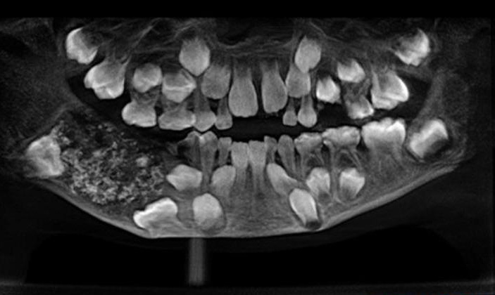Teeth-Xray-India-190801.jpg